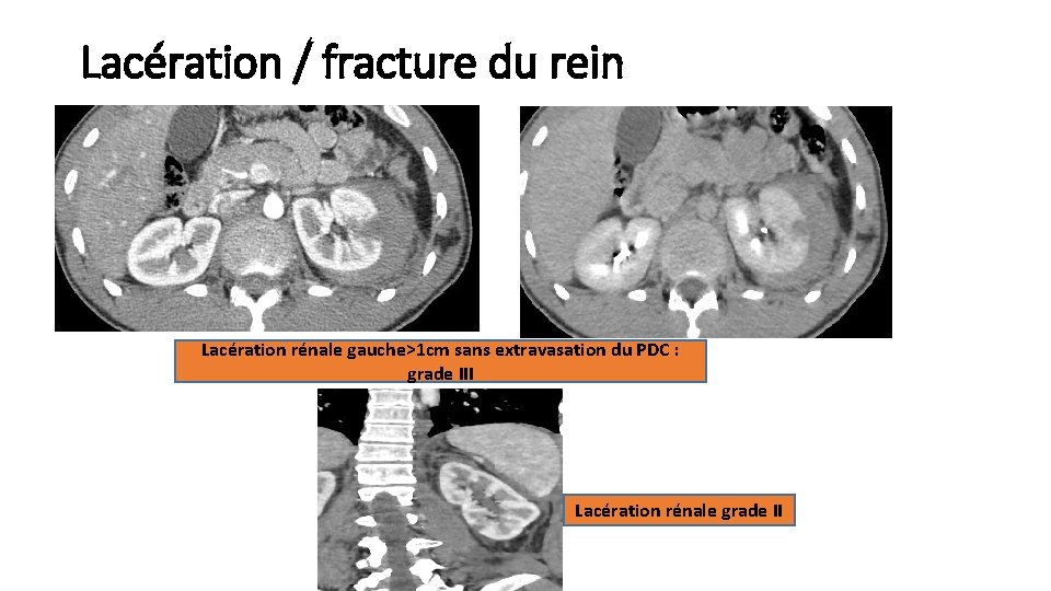 Lacération / fracture du rein Lacération rénale gauche>1 cm sans extravasation du PDC :