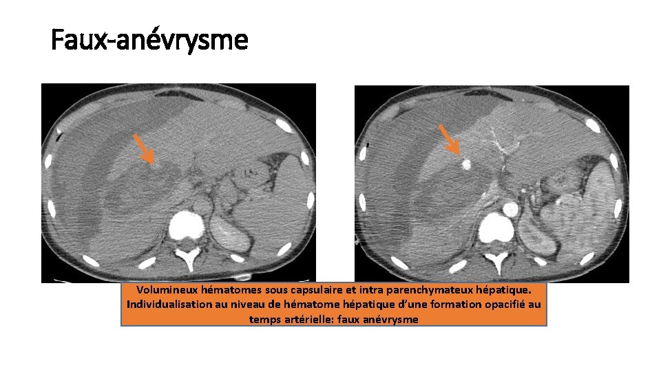 Faux-anévrysme Volumineux hématomes sous capsulaire et intra parenchymateux hépatique. Individualisation au niveau de hématome