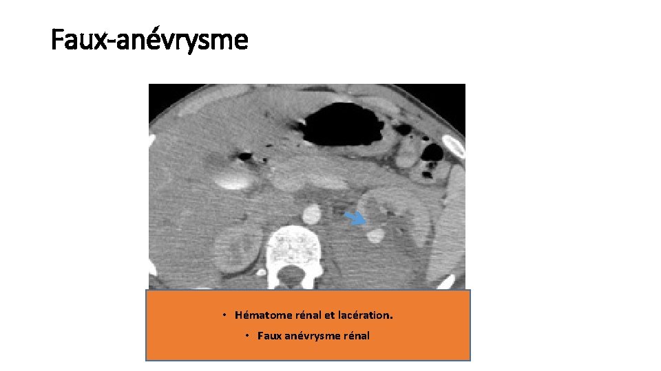 Faux-anévrysme • Hématome rénal et lacération. • Faux anévrysme rénal 
