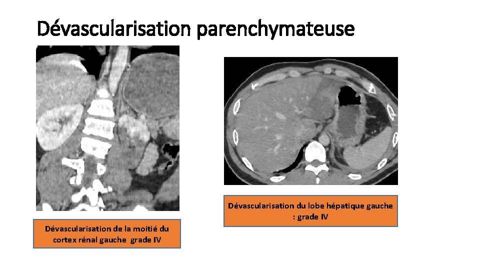 Dévascularisation parenchymateuse Dévascularisation du lobe hépatique gauche : grade IV Dévascularisation de la moitié