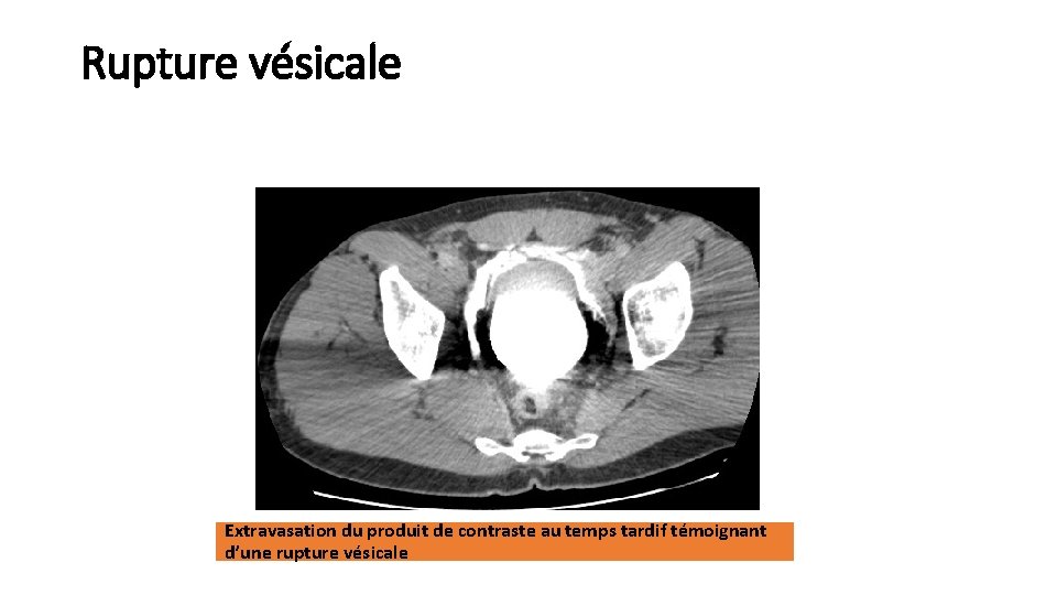 Rupture vésicale Extravasation du produit de contraste au temps tardif témoignant d’une rupture vésicale