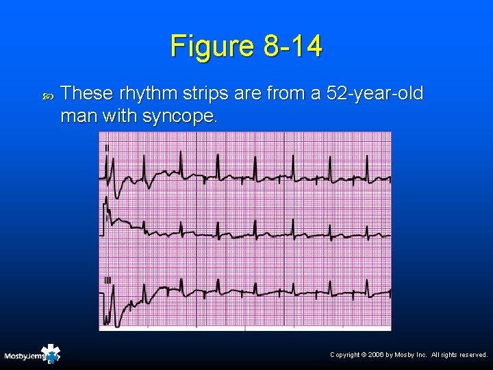 Figure 8 -14 These rhythm strips are from a 52 -year-old man with syncope.