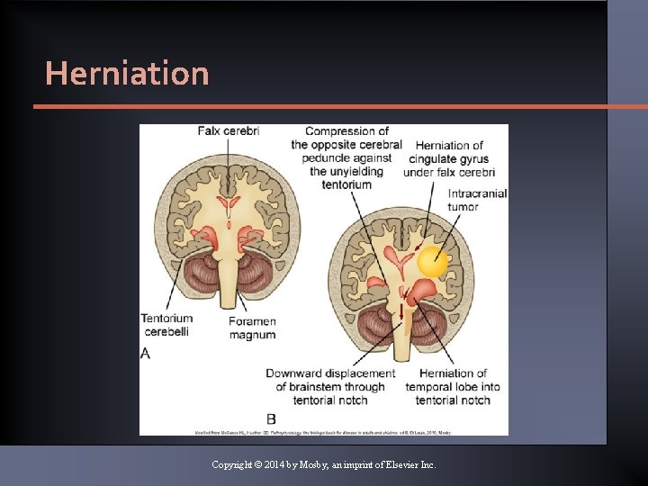 Herniation Copyright © 2014 by Mosby, an imprint of Elsevier Inc. 