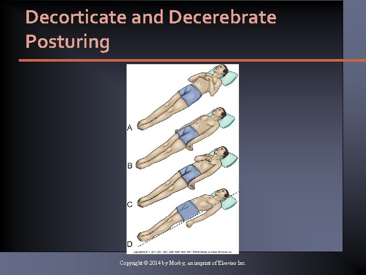 Decorticate and Decerebrate Posturing Copyright © 2014 by Mosby, an imprint of Elsevier Inc. Decorticate and Decerebrate Posturing Copyright © 2014 by Mosby, an imprint of Elsevier Inc.