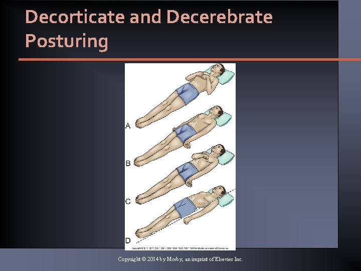 Decorticate and Decerebrate Posturing Copyright © 2014 by Mosby, an imprint of Elsevier Inc.