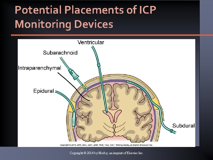 Potential Placements of ICP Monitoring Devices Copyright © 2014 by Mosby, an imprint of