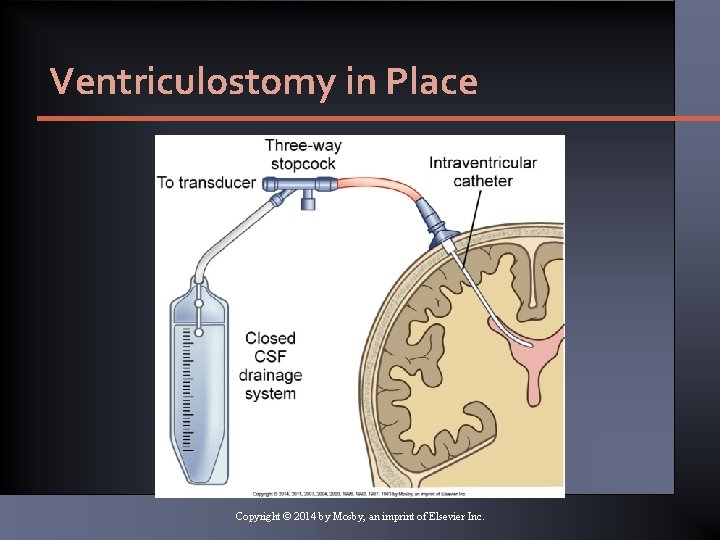 Ventriculostomy in Place Copyright © 2014 by Mosby, an imprint of Elsevier Inc. Ventriculostomy in Place Copyright © 2014 by Mosby, an imprint of Elsevier Inc.