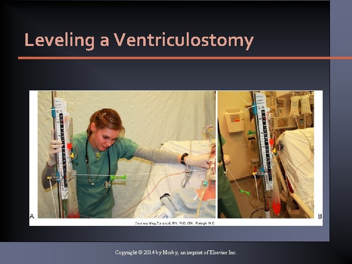 Leveling a Ventriculostomy Copyright © 2014 by Mosby, an imprint of Elsevier Inc. Leveling a Ventriculostomy Copyright © 2014 by Mosby, an imprint of Elsevier Inc.