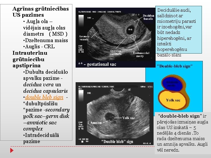 Agrīnas grūtniecības US pazīmes • Augļa ola – vidējais augļa olas diametrs ( MSD