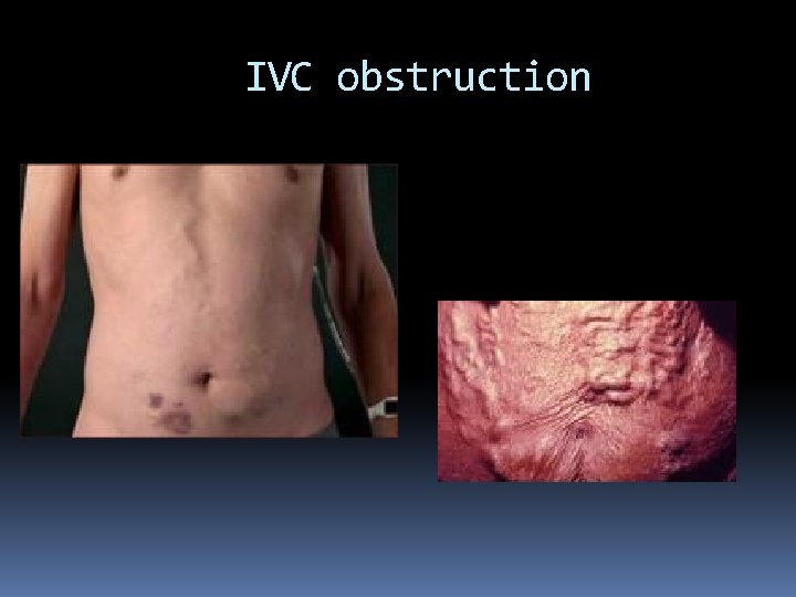 IVC obstruction 