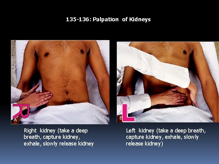 135 -136: Palpation of Kidneys Right kidney (take a deep breath, capture kidney, exhale,