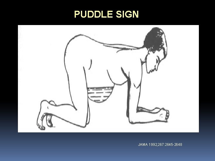 PUDDLE SIGN JAMA 1992; 267: 2645 -2648 