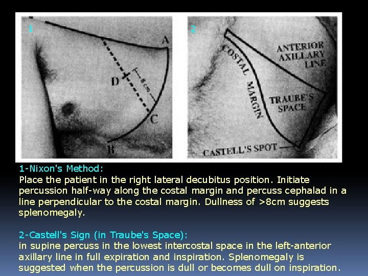 1 2 1 -Nixon's Method: Place the patient in the right lateral decubitus position.