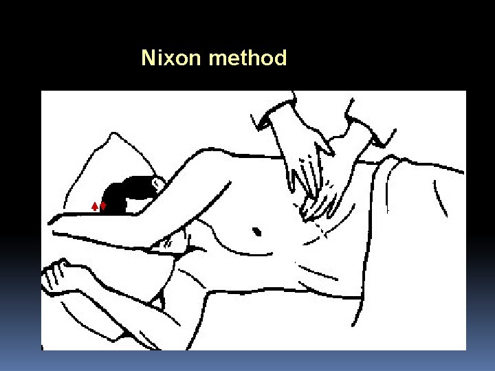 Nixon method 