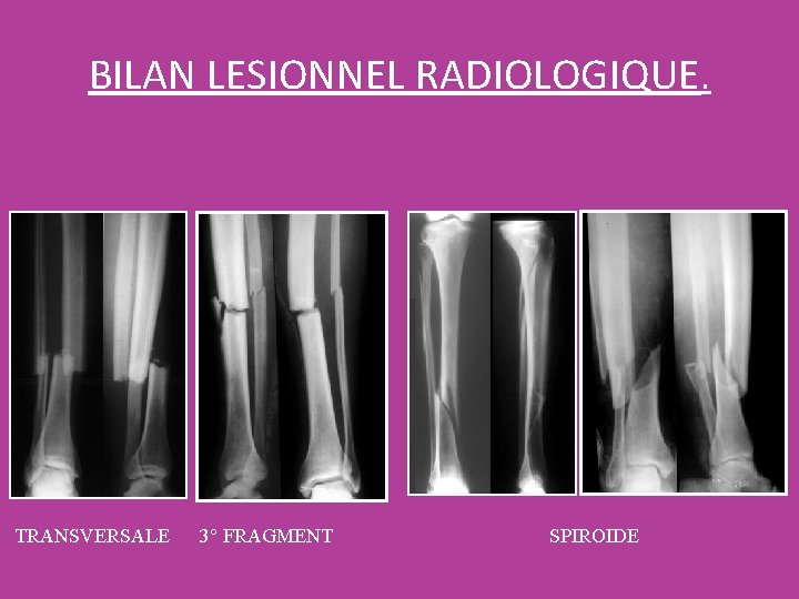 BILAN LESIONNEL RADIOLOGIQUE. TRANSVERSALE 3° FRAGMENT SPIROIDE 