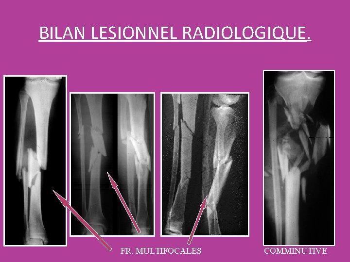 BILAN LESIONNEL RADIOLOGIQUE. FR. MULTIFOCALES COMMINUTIVE BILAN LESIONNEL RADIOLOGIQUE. FR. MULTIFOCALES COMMINUTIVE