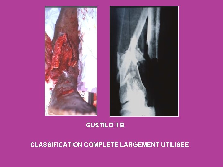 GUSTILO 3 B CLASSIFICATION COMPLETE LARGEMENT UTILISEE 