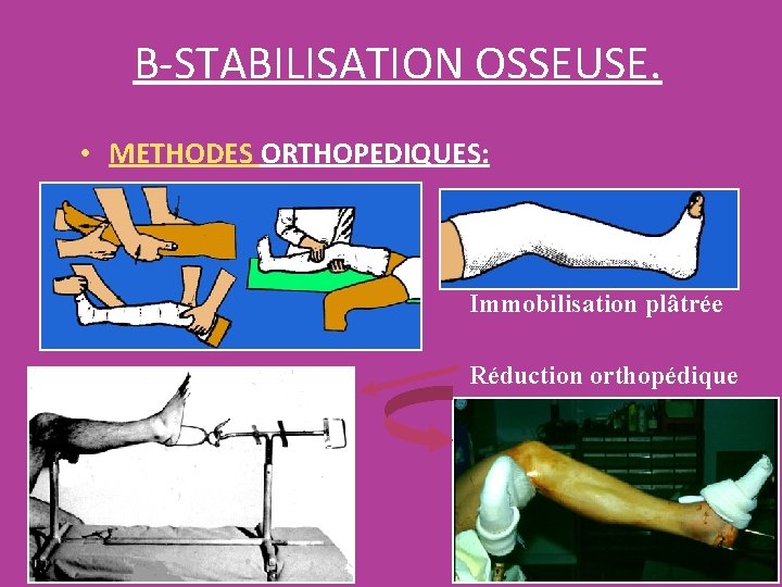 B-STABILISATION OSSEUSE. • METHODES ORTHOPEDIQUES: Immobilisation plâtrée Réduction orthopédique B-STABILISATION OSSEUSE. • METHODES ORTHOPEDIQUES: Immobilisation plâtrée Réduction orthopédique