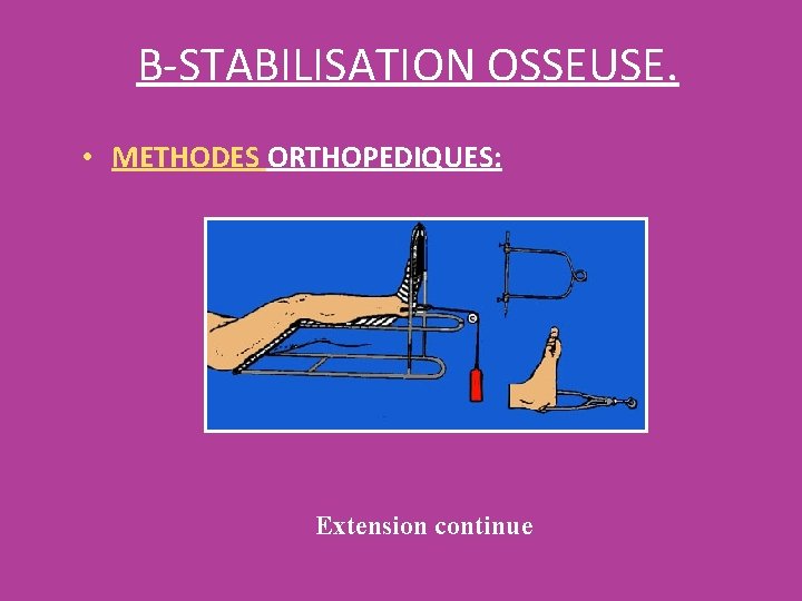 B-STABILISATION OSSEUSE. • METHODES ORTHOPEDIQUES: Extension continue B-STABILISATION OSSEUSE. • METHODES ORTHOPEDIQUES: Extension continue