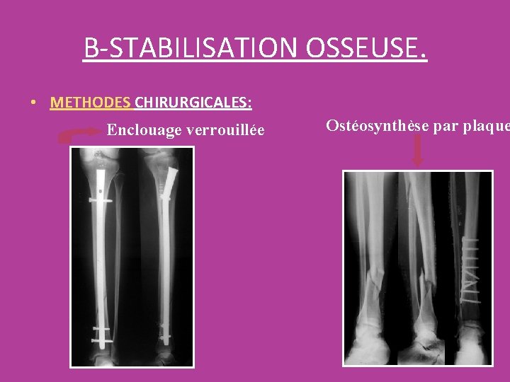 B-STABILISATION OSSEUSE. • METHODES CHIRURGICALES: Enclouage verrouillée Ostéosynthèse par plaque 