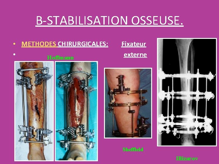 B-STABILISATION OSSEUSE. • METHODES CHIRURGICALES: • Hoffmann Fixateur externe Sheffield Illizarov B-STABILISATION OSSEUSE. • METHODES CHIRURGICALES: • Hoffmann Fixateur externe Sheffield Illizarov