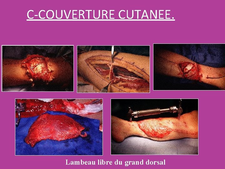 C-COUVERTURE CUTANEE. Lambeau libre du grand dorsal C-COUVERTURE CUTANEE. Lambeau libre du grand dorsal