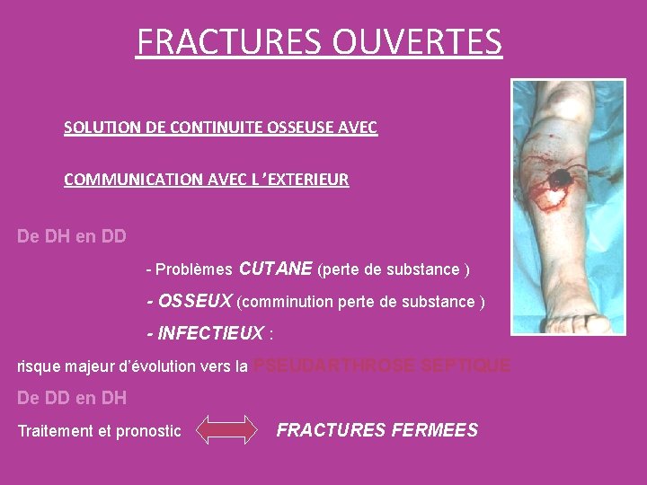 FRACTURES OUVERTES SOLUTION DE CONTINUITE OSSEUSE AVEC COMMUNICATION AVEC L ’EXTERIEUR De DH en