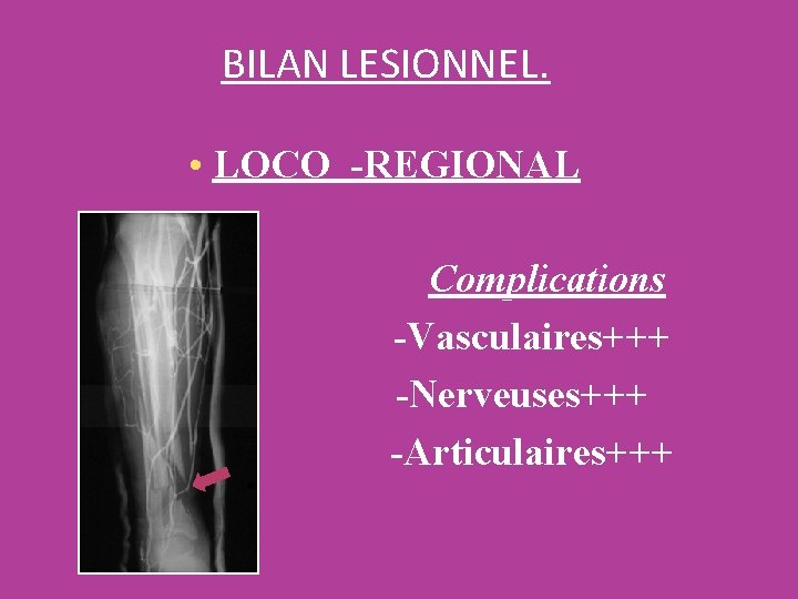 BILAN LESIONNEL. • LOCO -REGIONAL Complications -Vasculaires+++ -Nerveuses+++ -Articulaires+++ 