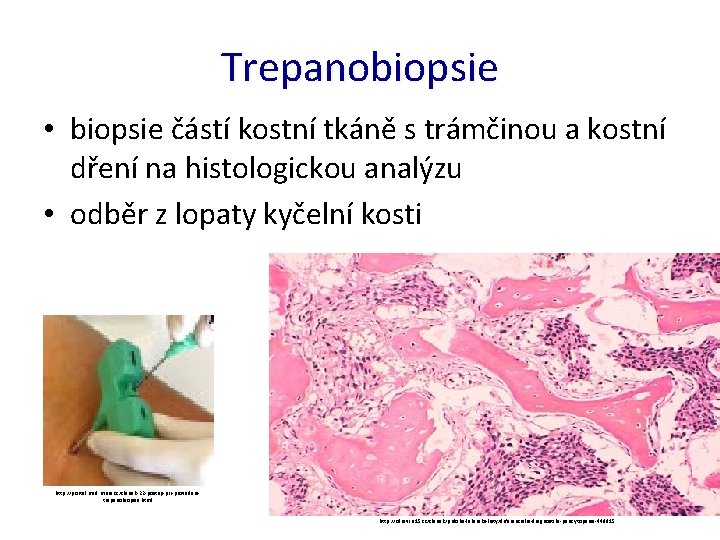 Trepanobiopsie • biopsie částí kostní tkáně s trámčinou a kostní dření na histologickou analýzu