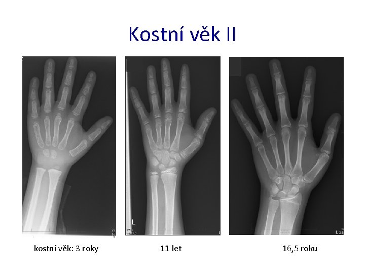 Kostní věk II kostní věk: 3 roky 11 let 16, 5 roku 