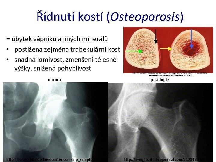 Řídnutí kostí (Osteoporosis) = úbytek vápníku a jiných minerálů • postižena zejména trabekulární kost