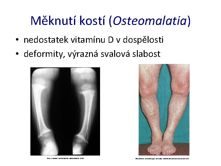 Měknutí kostí (Osteomalatia) • nedostatek vitamínu D v dospělosti • deformity, výrazná svalová slabost