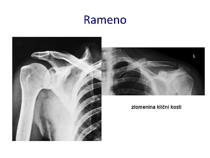 Rameno zlomenina klíční kosti 