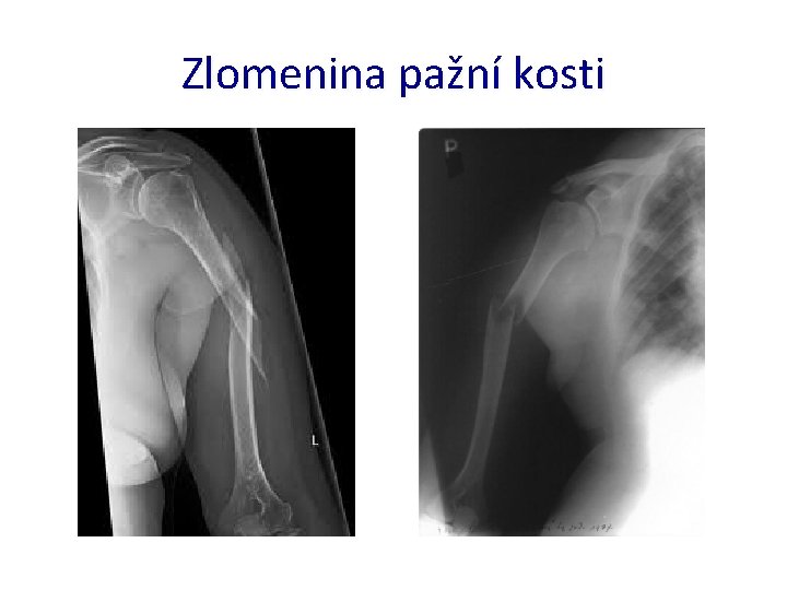 Zlomenina pažní kosti 