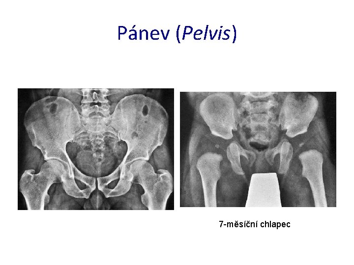 Pánev (Pelvis) 7 -měsíční chlapec 