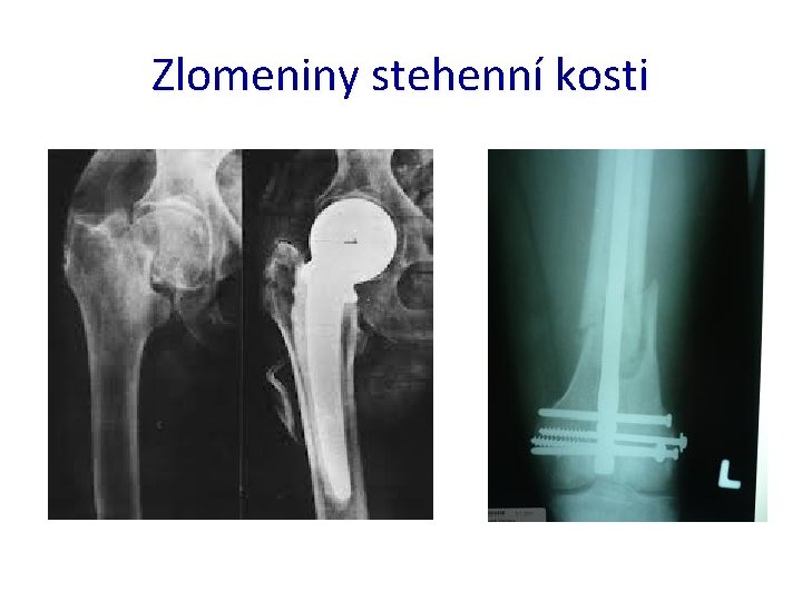 Zlomeniny stehenní kosti 