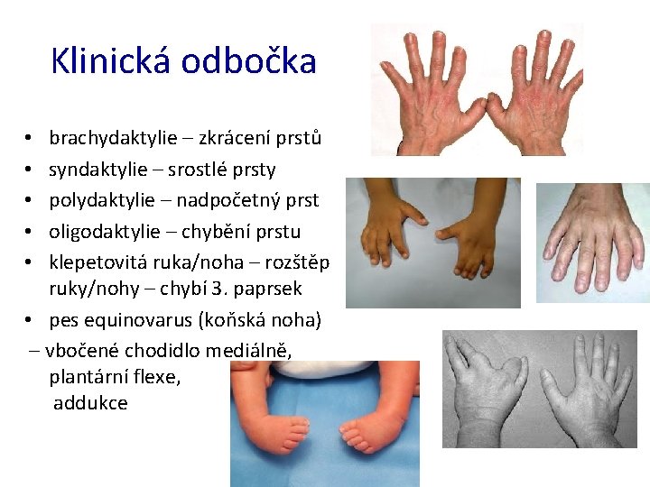 Klinická odbočka brachydaktylie – zkrácení prstů syndaktylie – srostlé prsty polydaktylie – nadpočetný prst