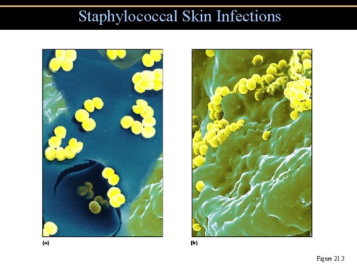 Staphylococcal Skin Infections Figure 21. 3 