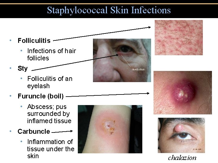 Staphylococcal Skin Infections • Folliculitis • Infections of hair follicles • Sty • Folliculitis