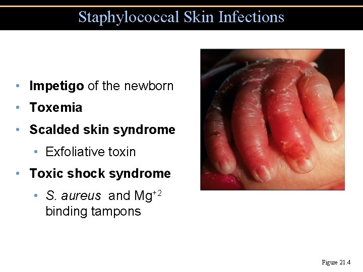 Staphylococcal Skin Infections • Impetigo of the newborn • Toxemia • Scalded skin syndrome