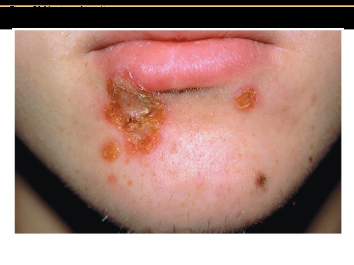 Figure 21. 4 Lesions of impetigo. Insert Fig 21. 4 