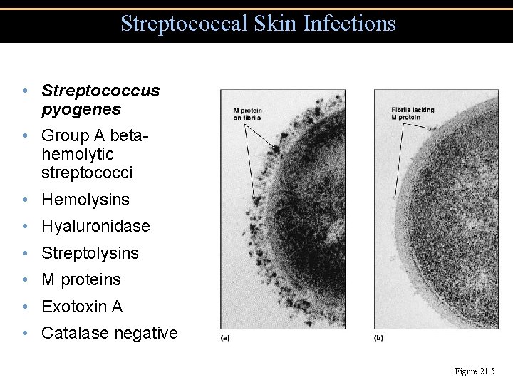 Streptococcal Skin Infections • Streptococcus pyogenes • Group A betahemolytic streptococci • Hemolysins •