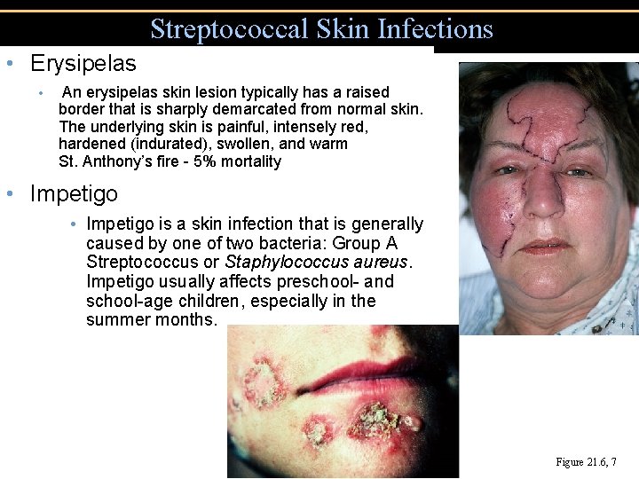Streptococcal Skin Infections • Erysipelas • An erysipelas skin lesion typically has a raised