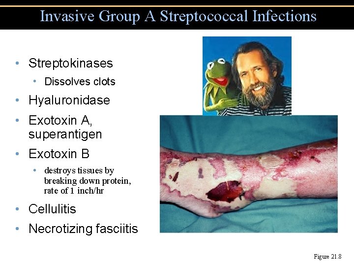 Invasive Group A Streptococcal Infections • Streptokinases • Dissolves clots • Hyaluronidase • Exotoxin