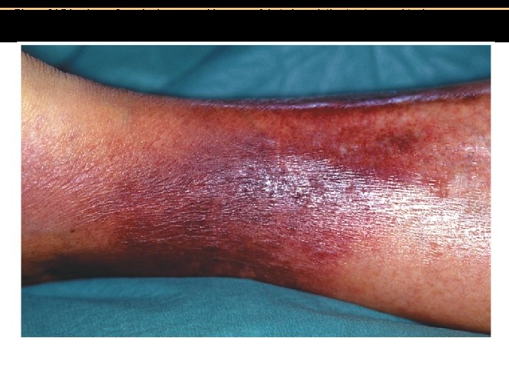 Figure 21. 7 Lesions of erysipelas, caused by group A beta-hemolytic streptococcal toxins. 