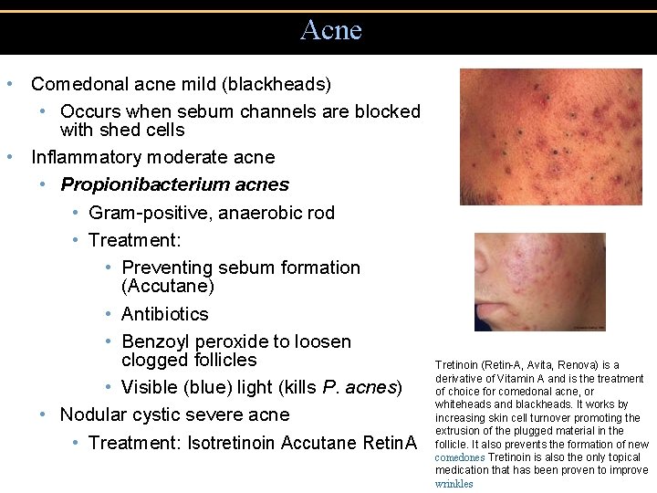 Acne • Comedonal acne mild (blackheads) • Occurs when sebum channels are blocked with