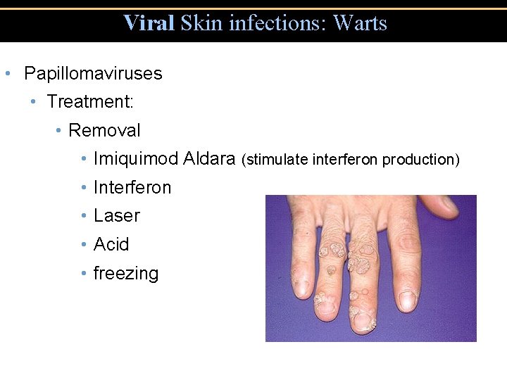 Viral Skin infections: Warts • Papillomaviruses • Treatment: • Removal • Imiquimod Aldara (stimulate