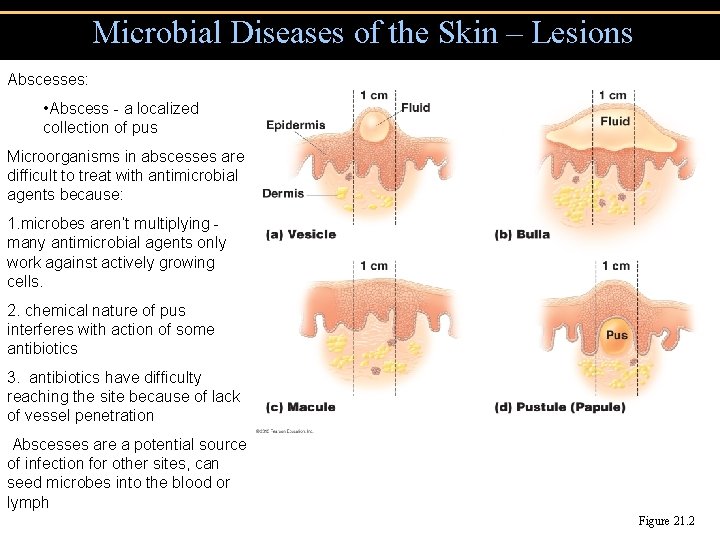 Microbial Diseases of the Skin – Lesions Abscesses: • Abscess - a localized collection