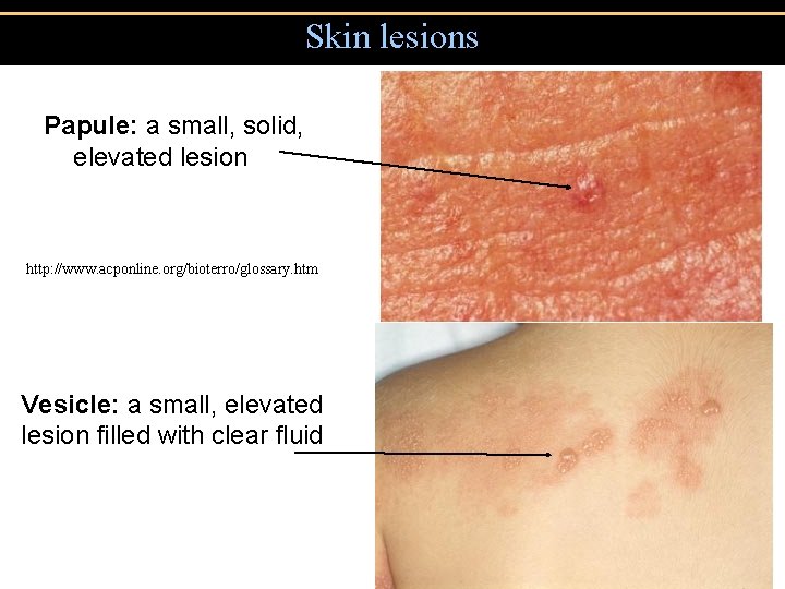 Skin lesions Papule: a small, solid, elevated lesion http: //www. acponline. org/bioterro/glossary. htm Vesicle: