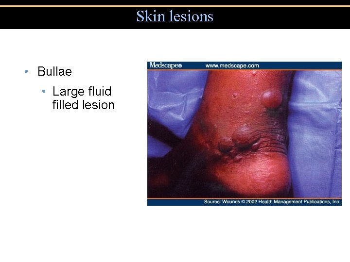 Skin lesions • Bullae • Large fluid filled lesion 